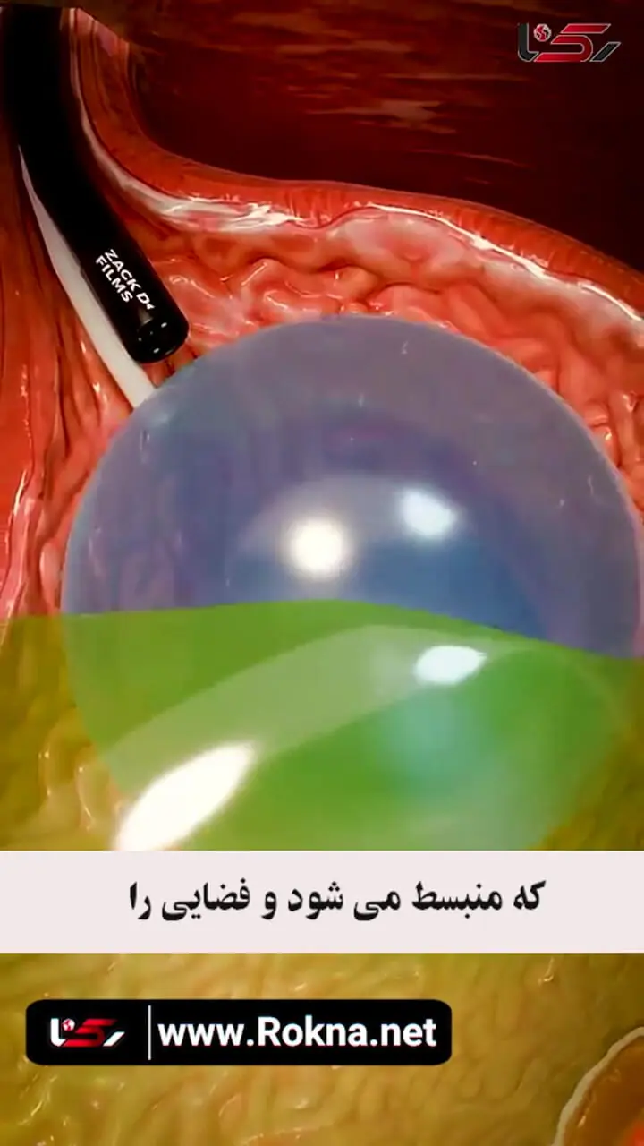 بالون معده چگونه کار می کند؟