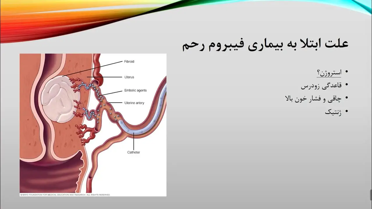 فیبروم رحم چیست ؟ + فیلم