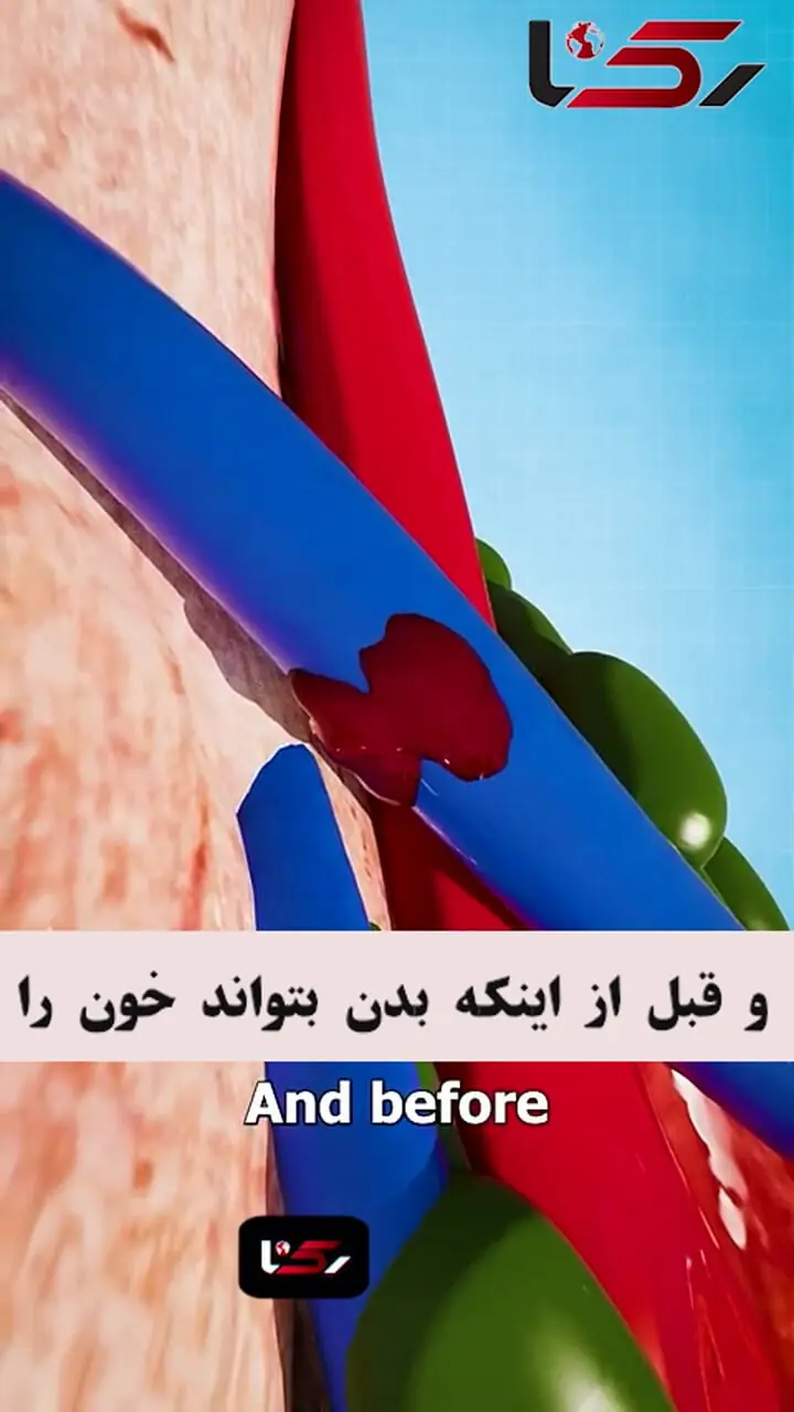 علت کبودی پوست بعد از واکسن + فیلم 