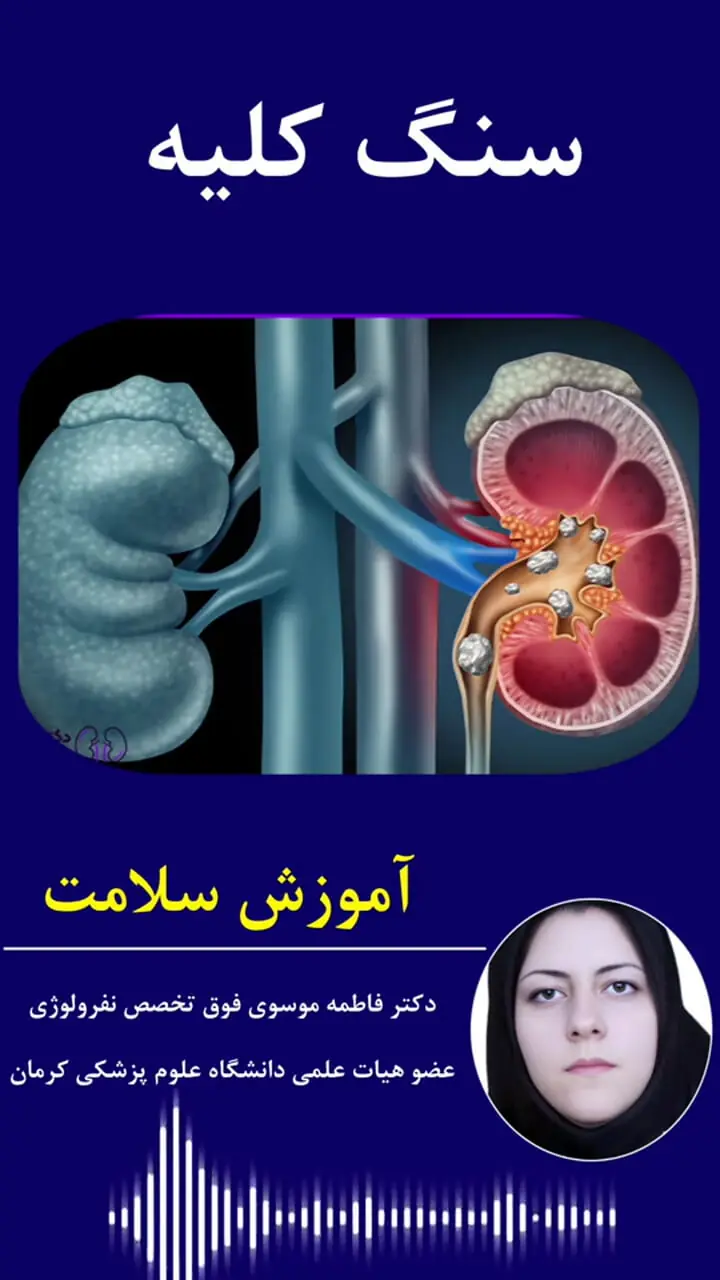 چه کار کنیم که دچار ابتلا به سنگ کلیه نشویم؟