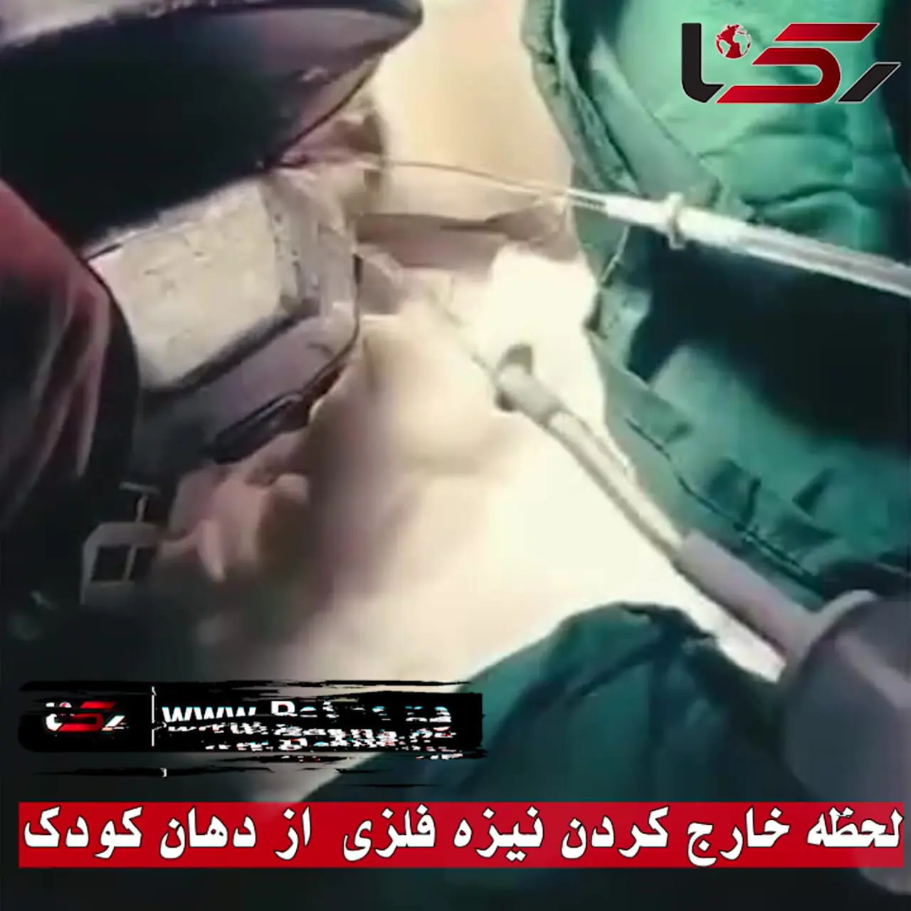 خارج کردن نیزه فلزی از دهان کودک ۱۱ ساله در ایرانشهر