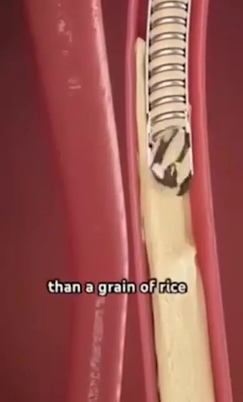 فیلم درمان سریع گرفتگی رگ قلب با ابزار الماسی